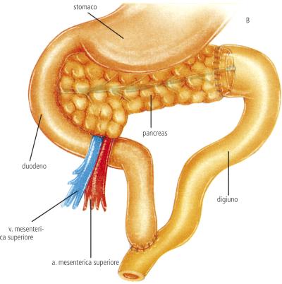 Pancreatite acuta e cronica